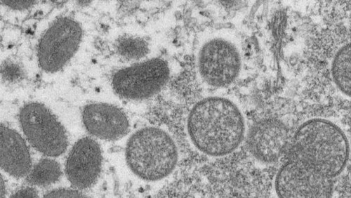 多國報告新增猴痘病例  法國首現兒童確診病例