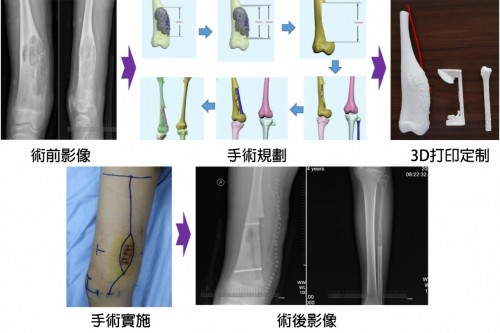 中國成功實施世界首例自體骨生物重建修復術